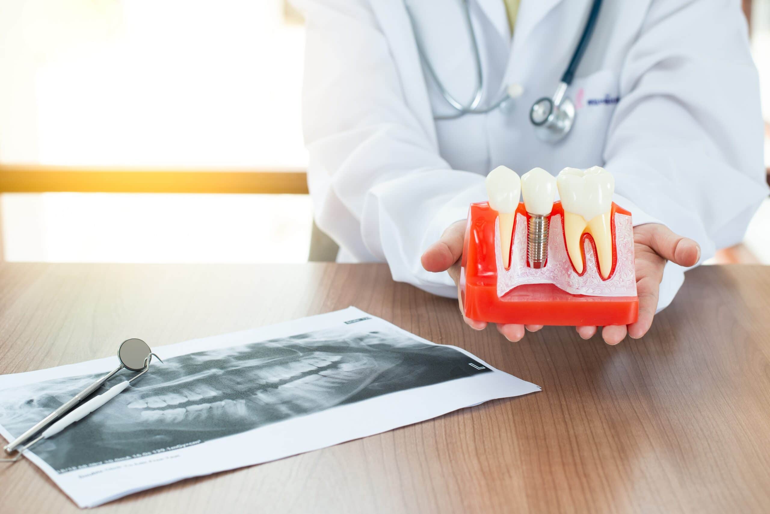 dental implant 4